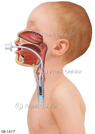 Notfall, Platzierung Larynx-Tubus beim Kind