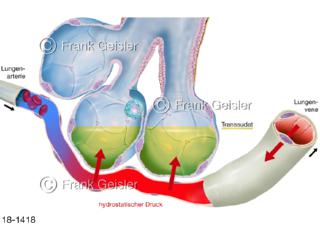 Notfall, hydrostatischer Druck Schweredruck in Lunge erhöht