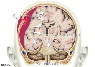Notfall, Hirndruck bei Schädel-Hirn-Blutung durch traumatische Verletzungen SHT