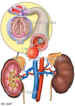 Sepsis Nieren Nierenkörperchen Gefäße