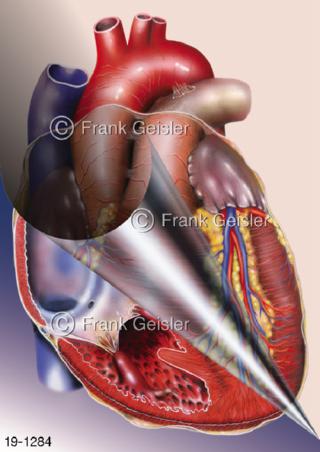 Medical-Art Kardiologie Herz Ventrikel