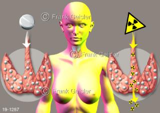 Medical-Art Radioaktivität Schilddrüe Therapie Arzneimittel Jod