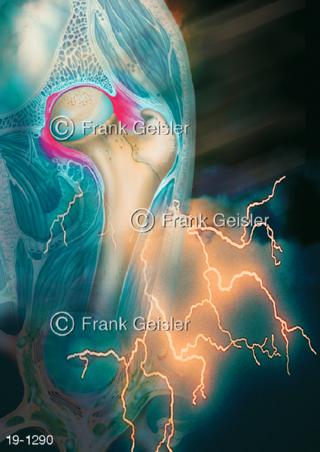 Medical-Art Erkrankung Hüftgelenk Arthrose Schmerzen