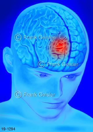 Medical-Art Kopf Kopfschmerz Migräne punktuell