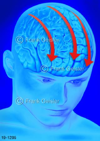 Medical-Art Kopf Kopfschmerz Migräne Spannungskopfschmerz