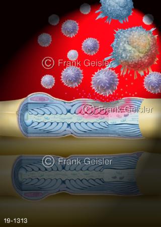 Medical-Art Multiple Sklerose MS, Rückenmark T-Zellen Monozyt Myelin