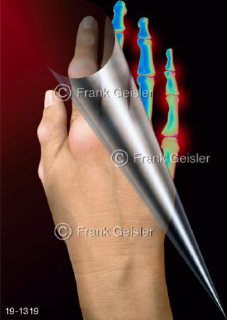 Medical-Art Hand Rheuma rheumatoide Arthritis