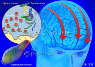 Medical-Art Poster Botox-Therapie bei Migräne Kopfschmerz