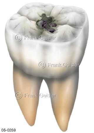 Zahn Molar, Zahnschmelz mit Karies