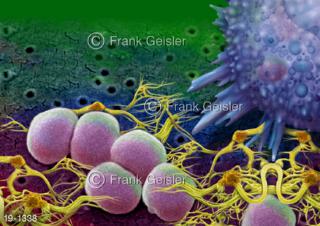 Medical-Art Abszess Eiter Staphylococcus aureus mit Fresszelle
