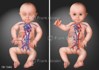 Medical-Art Fetus Baby praenataler postnataler Blutkreislauf