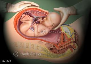 Medical-Art Baby Geburt Schnittentbindung Kaiserschnitt