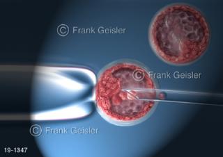 Medical-Art Embryologie, Blastocyst Entnahme Stammzellen