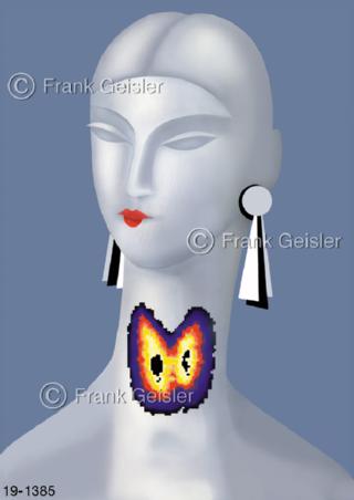 Medical-Art Schilddrüse Struma Frau