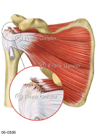 Muskeln Schultergelenk, Rotatorenmanschette mit Ruptur
