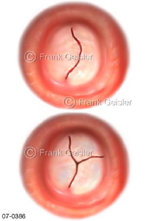 Herz, Mitralklappe Segelklappe Herzklappen