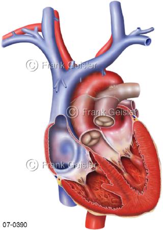 Herz, Hohlvene Aorta Lungenarterie Herzkammern