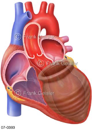 Herz Tintenfischfalle, Takotsubo-Stress-Kardiomyopathie