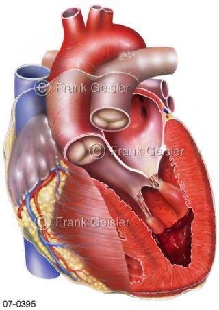 Herz, Ventrikelthrombus Herzventrikel Herzkammer