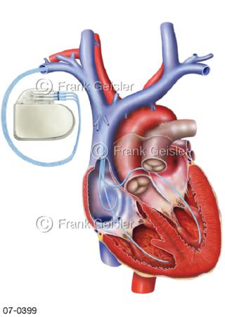 Herz, Herzschrittmacher bei Herzinsuffizienz