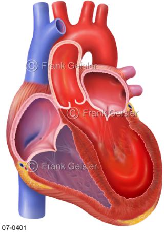 Herz mit Stresskardiomyopathie, Tako-Tsubo-Kardiomyopathie