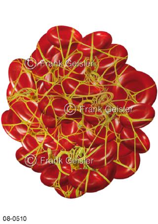 Gerinnsel Blutgerinnsel, Thrombus Blutzellen
