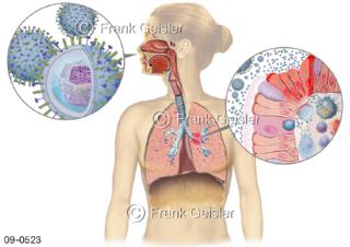 Immunreaktion Immunsystem, Grippe-Influenza-Viren in den Atemwegen