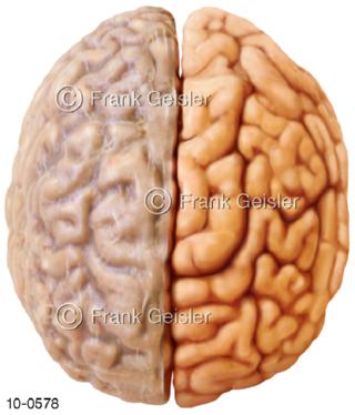Gehirn Hirnoberfläche mit Hirnhaut linksseitig