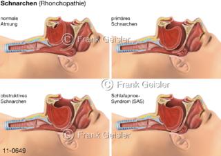 Atemsystem, Schnarchen Rhonchopathie und Atemaussetzer Schlafapnoe beim Schlaf