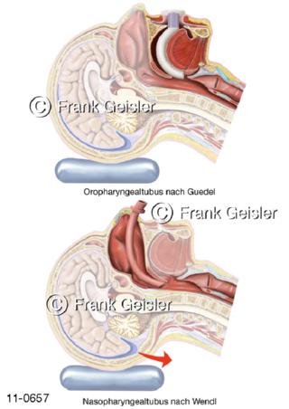 Pharyngealtuben Pharynx Rachen Schlund