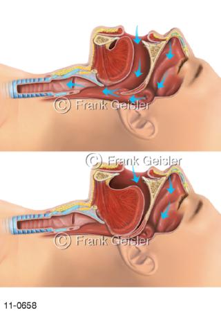  Mund-Nasen-Atmung und Schnarchen Schlafapnoe