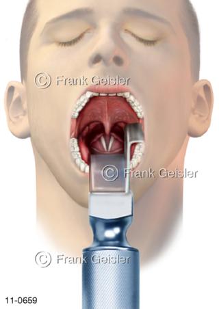 Mund Larynx, Laryngoskopie mit Laryngoskop