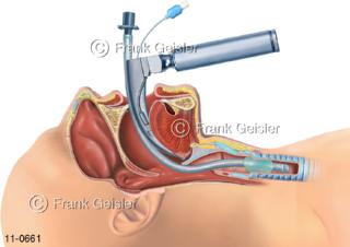 Intubation, Einführen Tubus über Mund in Luftröhre Trachea