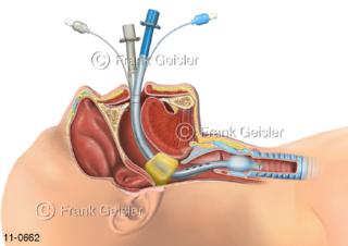 Intubation, Einführung Kombitubus Combitube Easytube in Luftröhre Trachea