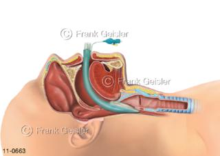 Platzierung Larynxmaske Kehlkopfmaske über Kehlkopf bei Narkose