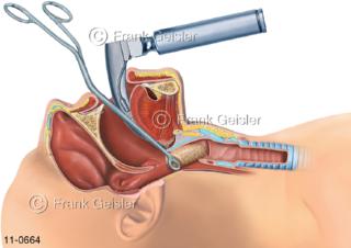 Eingriff mit Magill-Zange, Entfernung Fremdkörper aus Luftröhre Trachea