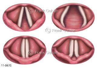  Kehlkopfspiegelbilder Stimmlippen Stimmfalten Stimmritze, Atmung und Sprache