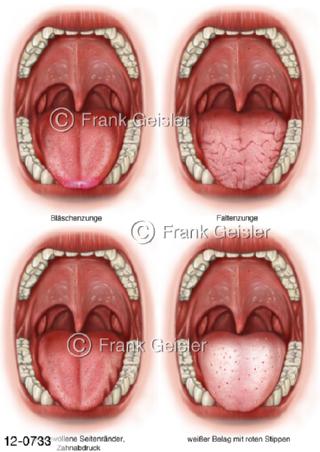 Mund mit Zunge, Diagnostik Zungenbelag