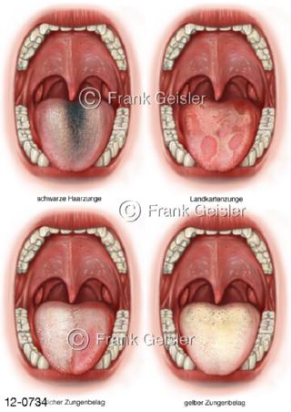 Mund mit Zunge, Diagnostik Zungenbelag