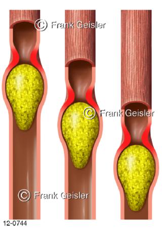 Peristaltik Nahrungstransport in Speiseröhre