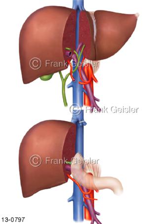 Leber Hepar Transplantation Leberresektion Split Lebertransplantation