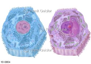 Zellen Leber Hepar, Leberzelle Hepatozyt bei Leberkrebs Leberkarzinom