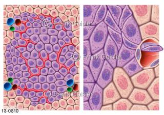 Leberzellen der Leber Hepar, Angiogenese Metastasierung Leberzellkarzinom