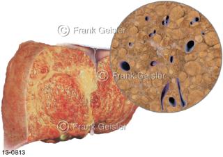 Erkrankung Leber Hepar, Leberzirrhose, Endstadium chronischer Lebererkrankungen