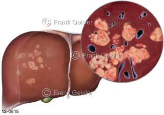 Leber Hepar mit Lebertumore Leberkrebs Hepatozelluläres Karzinom, ein seltener schwerwiegender Tumor