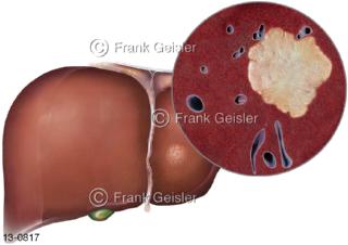 Leber Hepar Lebererkrankung Leberkrebs, Hepatozelluläres Karzinom