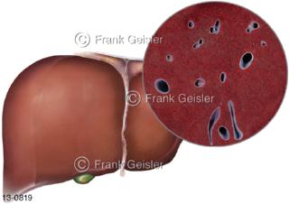 Verdauungsorgane Leber Hepar, gesundes Organ mit Histologie Lebergewebe