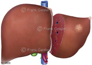 Verdauungsorgan Leber, Resektion bei Leberkrebs Lebertumor