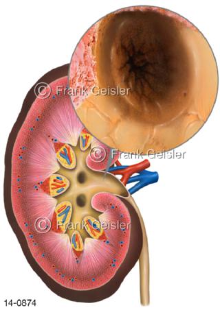 Niere, Längsschnitt mit Ansicht Nierenbecken
