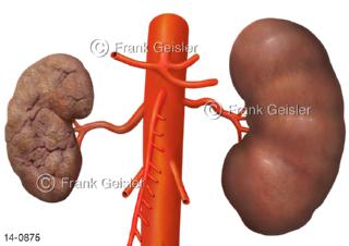 Niere und Schrumpfniere Nephrozirrhose, Endstadium chronischer Nierenerkrankungen